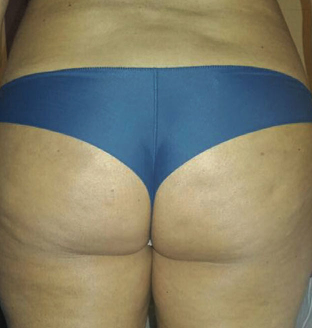 Celulitis en glúteos y muslos antes de Endospheres en Valencia
