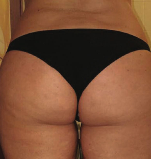 Glúteos y muslos después de Endospheres, celulitis reducida