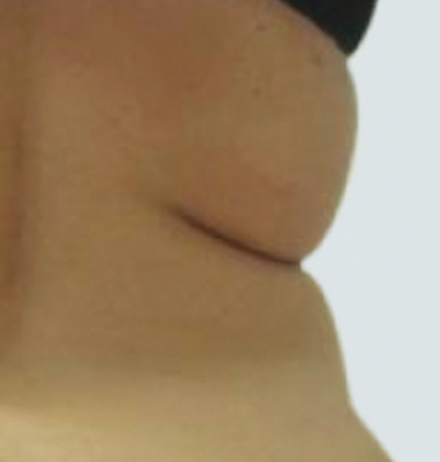 Abdomen y cintura antes del tratamiento Endospheres corporal