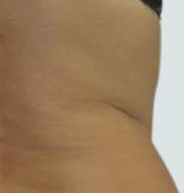 Abdomen y cintura después de Endospheres, contorno reafirmado